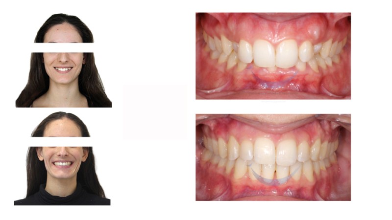 Traitement orthodontique multi-bagues céramiques