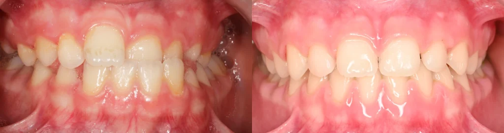 Cas de correction d’une occlusion inversée